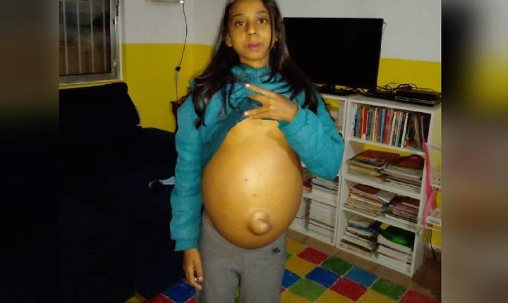 Adolescente com 'barriga gigante' faz apelo para conseguir cirurgia no fígado e remédios para tratamento, em Aragoiânia