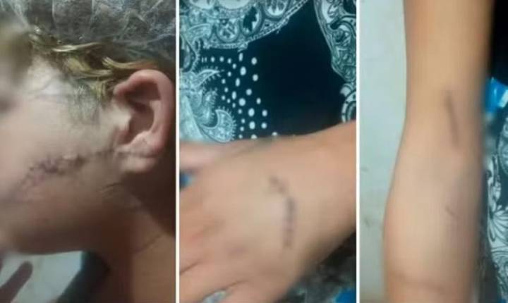Ex-marido é preso suspeito de cortar o rosto e orelha de mulher