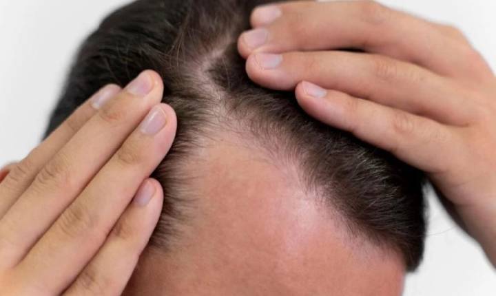 Mounjaro pode causar queda de cabelo e acelerar a calvície? Especialista responde