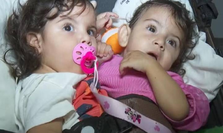 Siamesas de São Paulo unidas pelo abdômen e bacia são internadas para cirurgia de separação em Goiânia