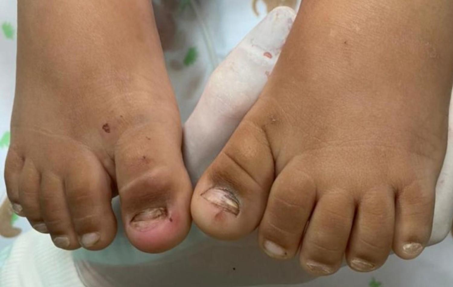 Polícia investiga maus-tratos a menina de 2 anos que foi levada a hospital sem duas unhas e com lesões no intestino