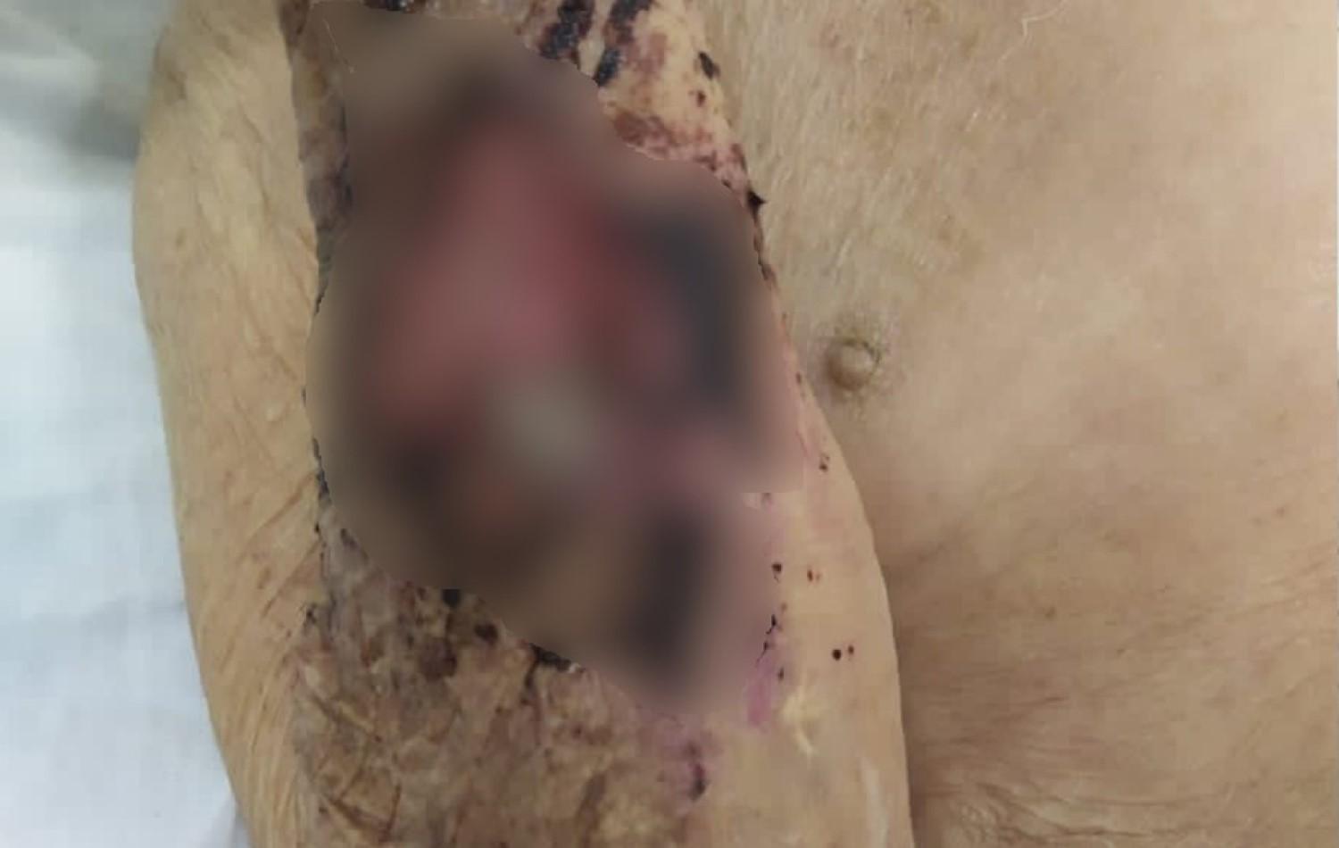 Filho é preso suspeito de maus-tratos a idoso encontrado desidratado e com larvas em ferida, em Goiânia