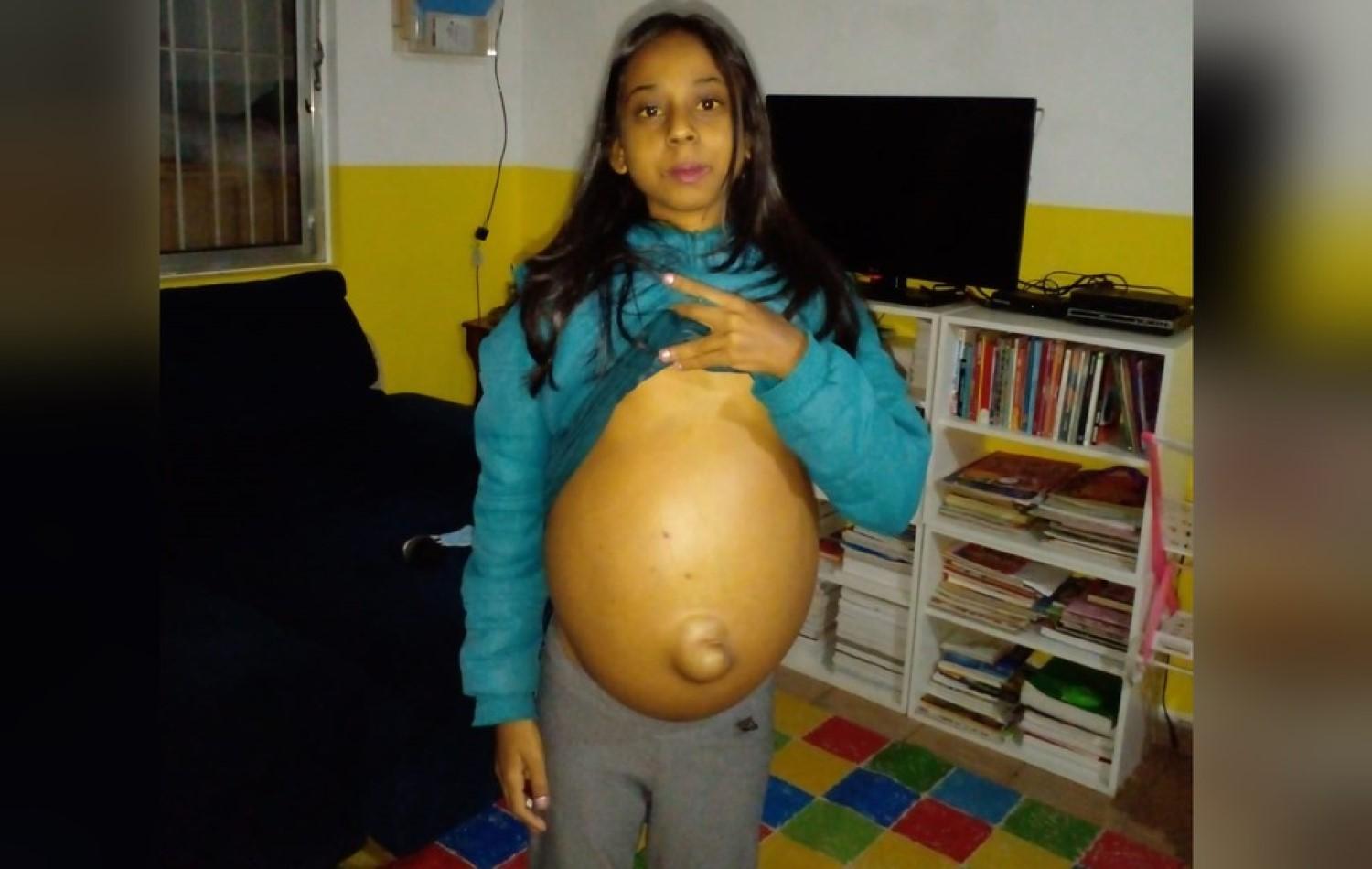 Adolescente com 'barriga gigante' faz apelo para conseguir cirurgia no fígado e remédios para tratamento, em Aragoiânia