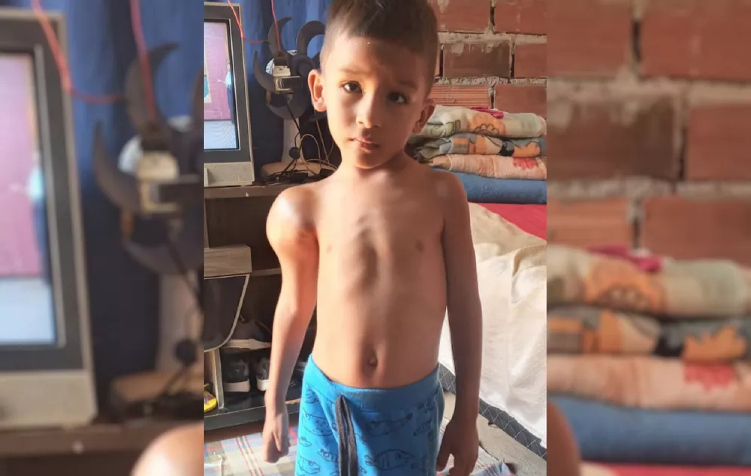 Criança de 3 anos com tumor no braço precisa de cirurgia com urgência em Aparecida de Goiânia