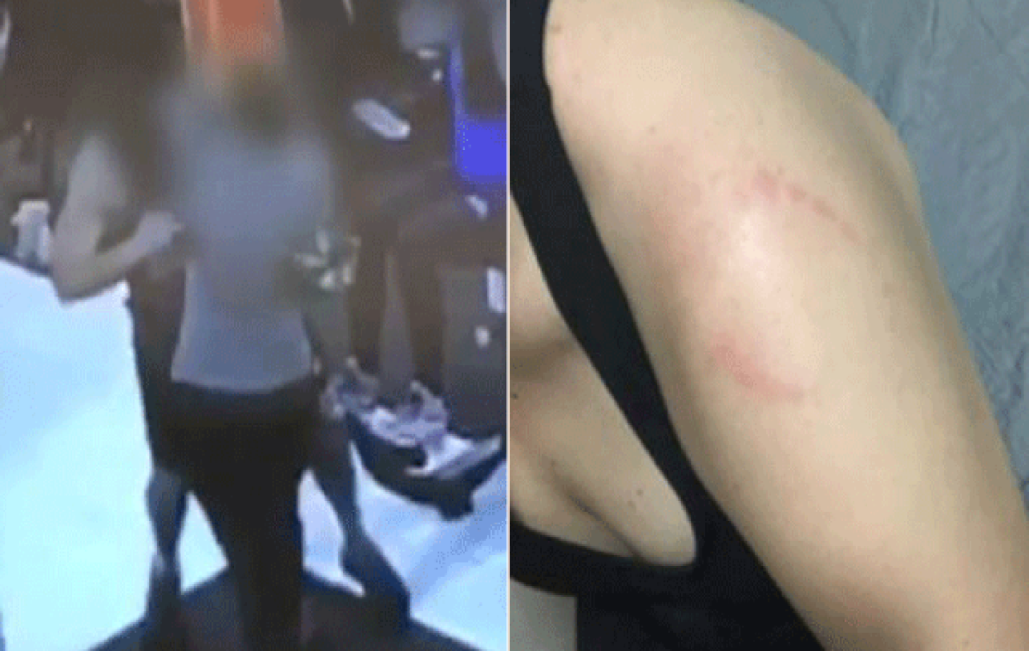 Jovem diz que foi mordida por homem no 1º dia em que treinou na academia e está assustada: ‘Ele ficava rindo’