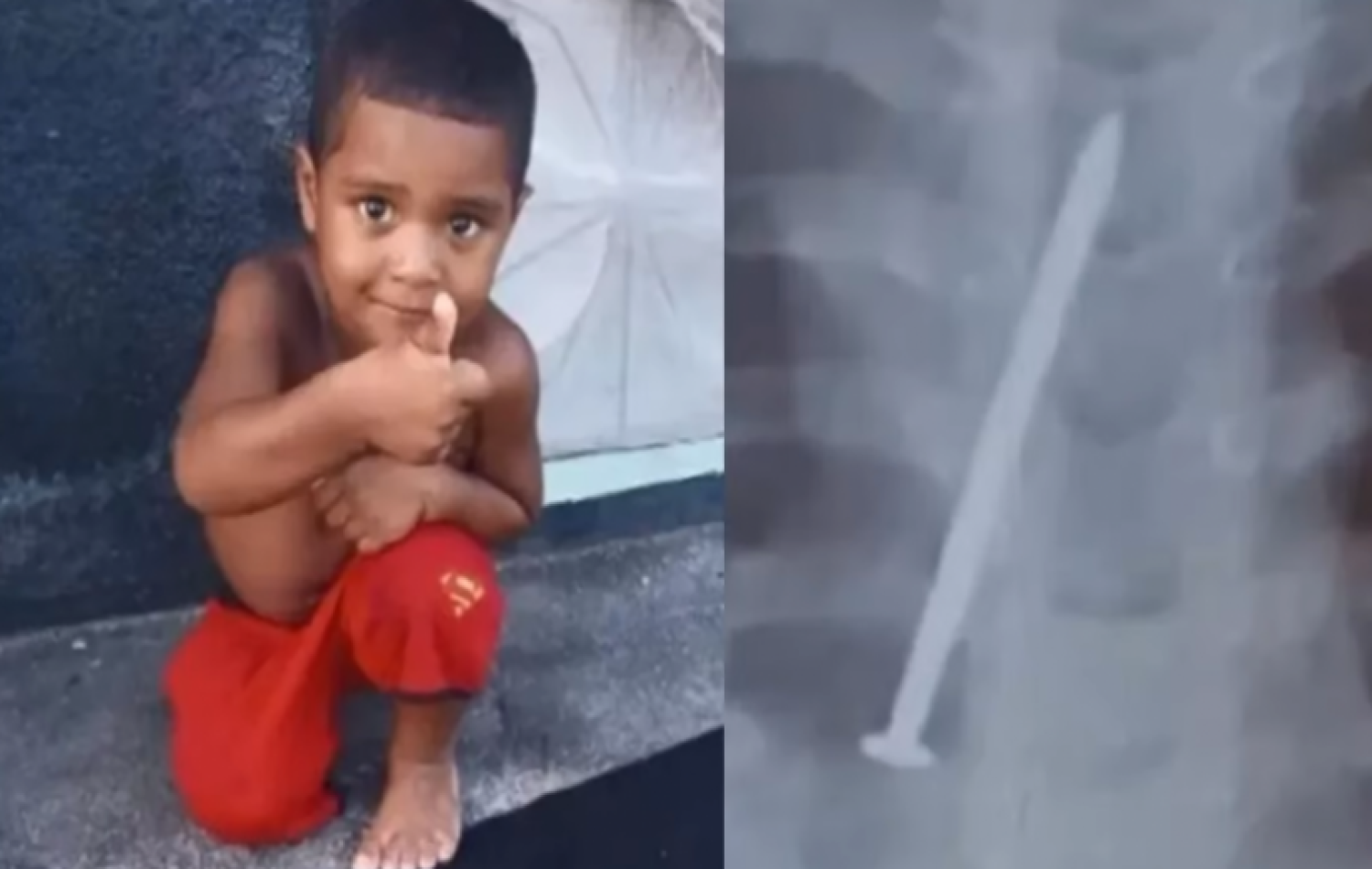 Menino morre após passar um ano com prego no pulmão, na Bahia