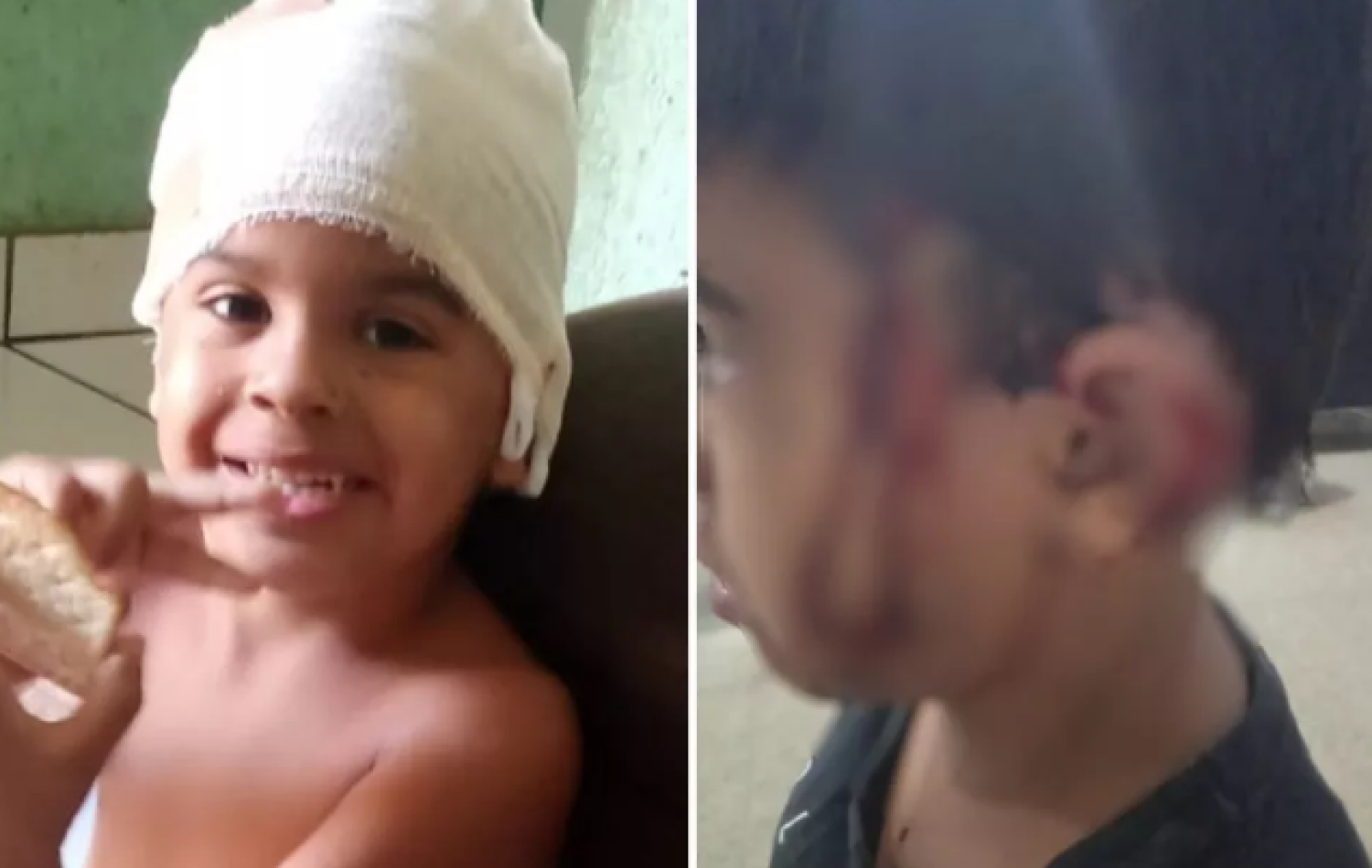 Menino perde parte da orelha ao ser atacado por cachorra enquanto passeava com a mãe, em Aparecida de Goiânia