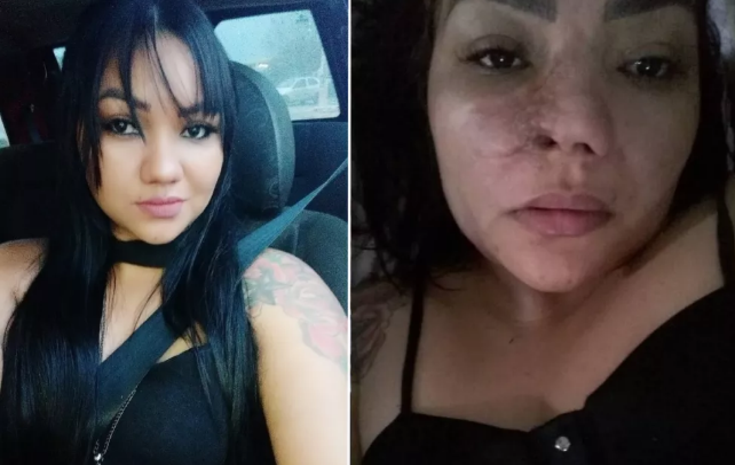 Mulher denuncia que perdeu parte do nariz e ficou com sequela após cirurgia estética com dentista