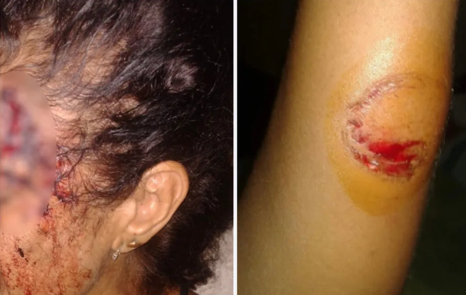 Homem é preso suspeito de morder e espancar a mãe até quebrar ossos, em Anápolis