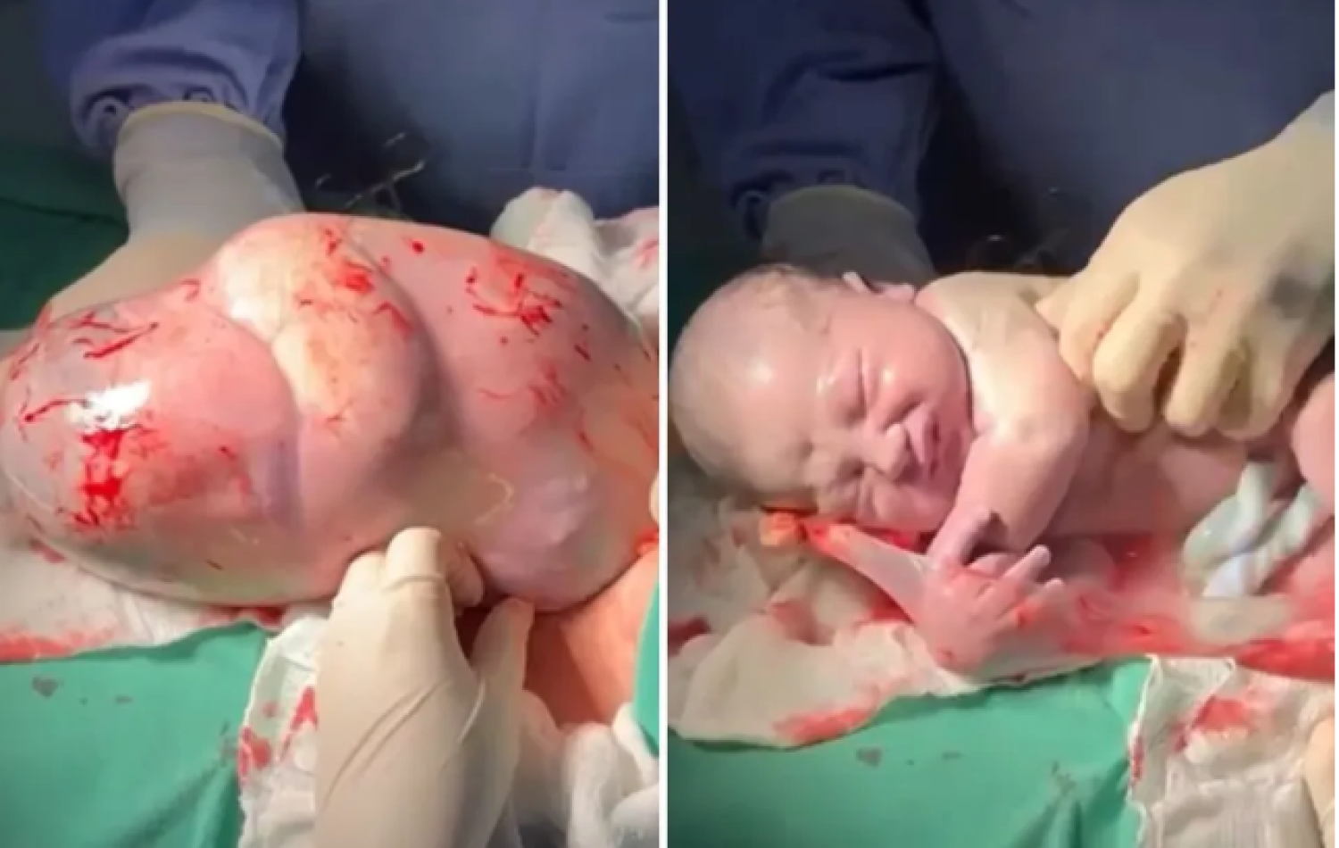 Bebê nasce empelicado e médico faz cócegas na barriga dele para acordá-lo