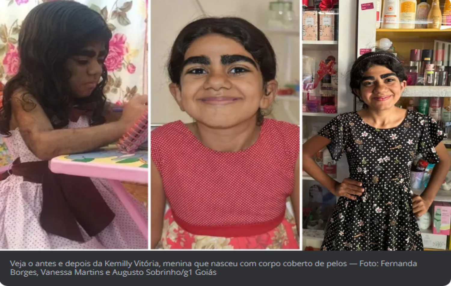 Influencer de beleza e esbanjando autoestima: veja como está a menina que nasceu com o corpo coberto de pelos