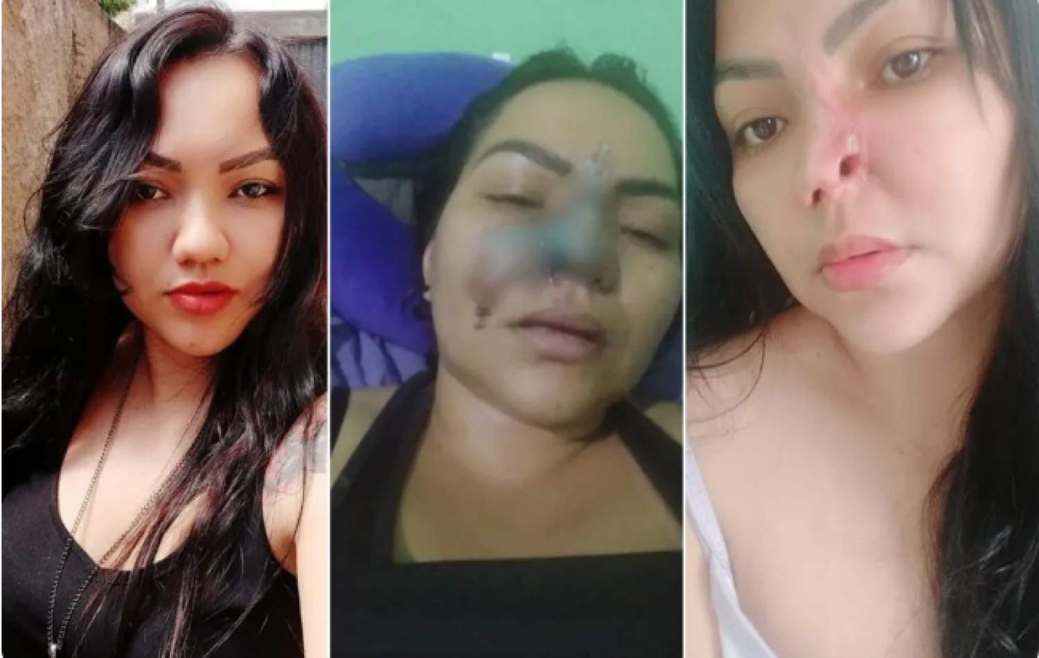 Mulher que perdeu parte do nariz após cirurgia estética com dentista