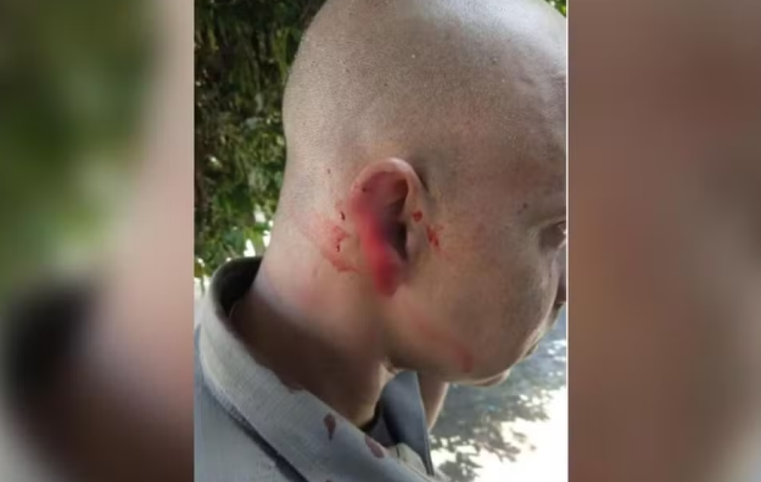 Policial que teve parte de orelha arrancada diz que só notou mordida após colega avisar: ‘Marca de guerra’