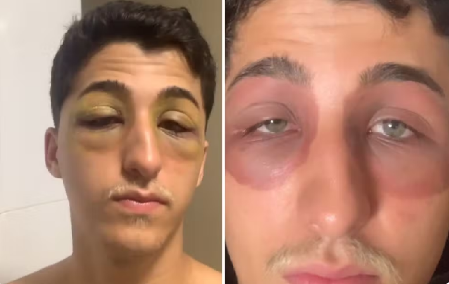 Jovem intriga web ao mostrar que acordou com hematomas e inchaços nos olhos sem saber o motivo