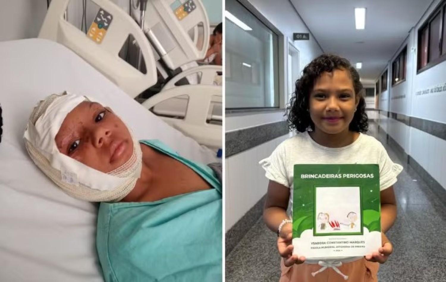 Criança que sofreu queimadura no rosto durante brincadeira supera trauma e escreve livro: ‘Dias de muita luta’