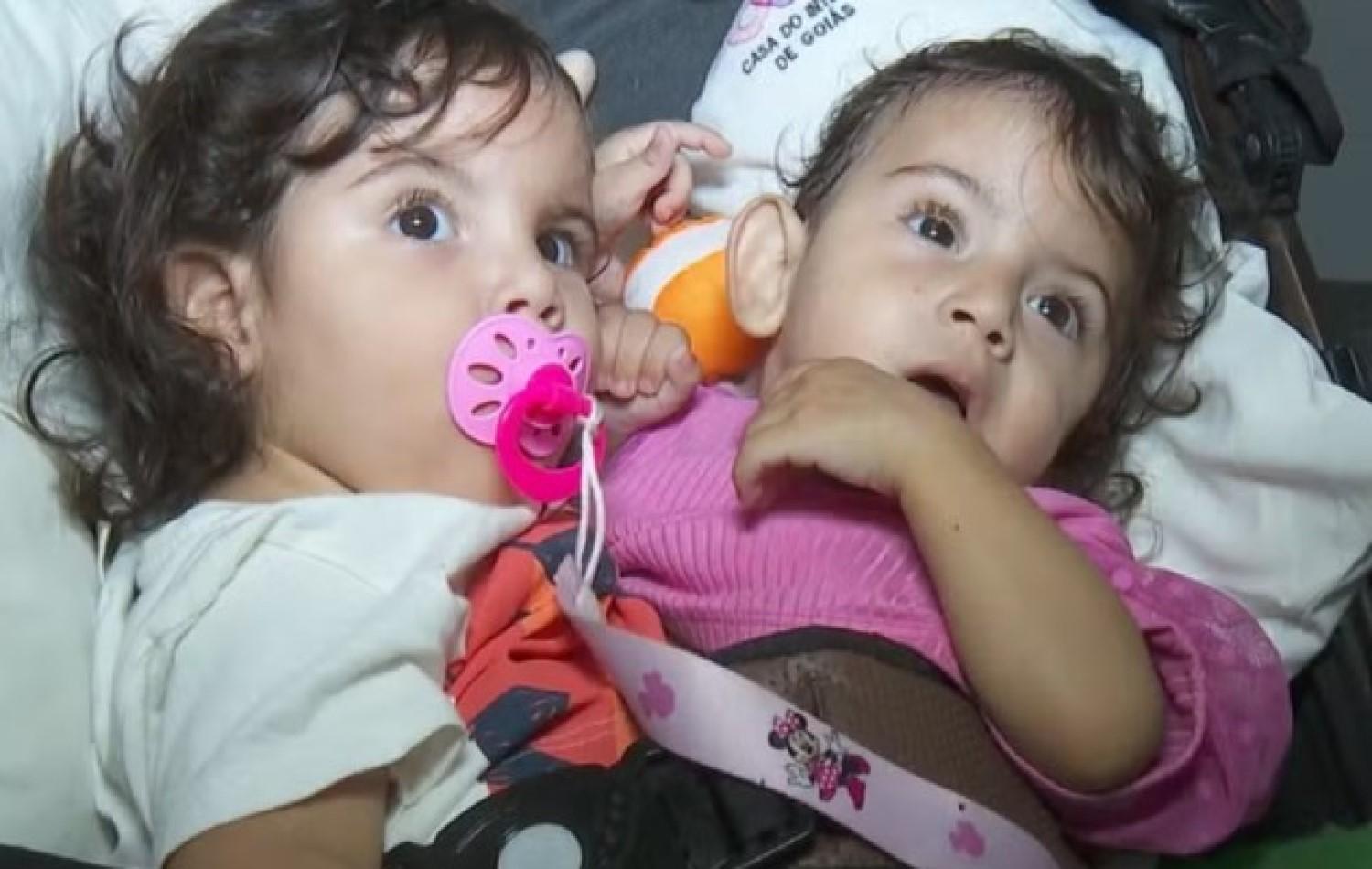 Siamesas de São Paulo unidas pelo abdômen e bacia são internadas para cirurgia de separação em Goiânia