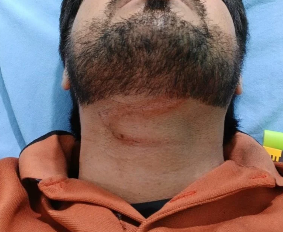 Jovem sofre queda de motocicleta após enroscar pescoço em fio solto no Centro de Chapadão do Sul