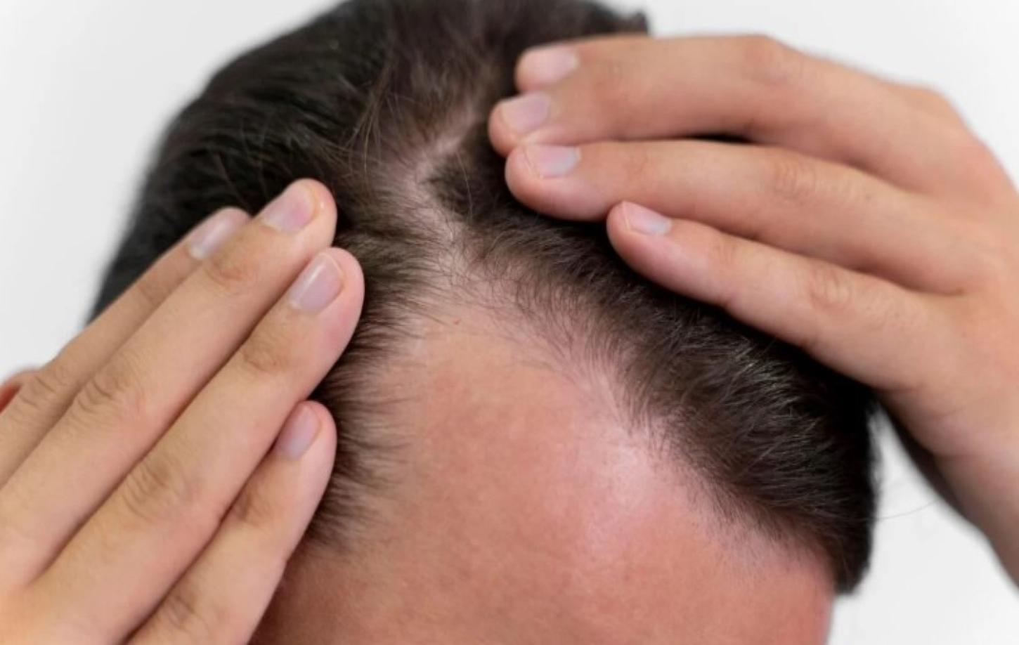 Mounjaro pode causar queda de cabelo e acelerar a calvície? Especialista responde