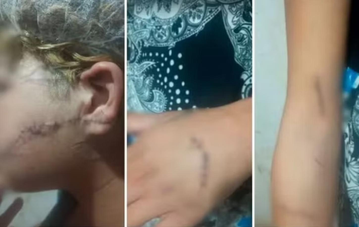 Ex-marido é preso suspeito de cortar o rosto e orelha de mulher